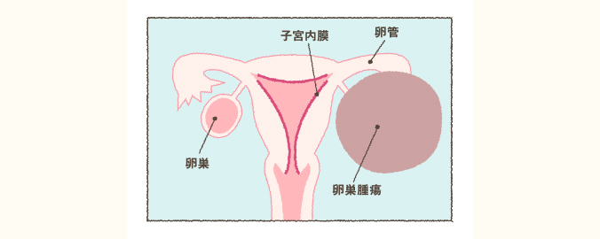 卵巣 嚢腫 と は